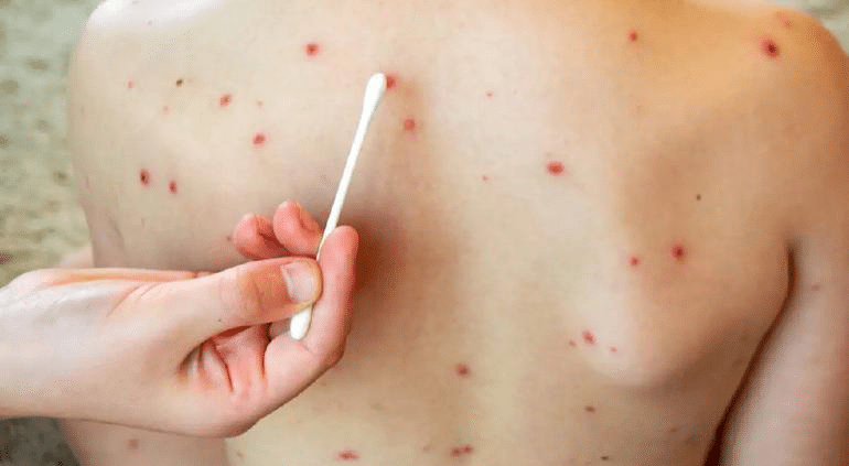 3 mil 703 casos de sarampión en Chihuahua