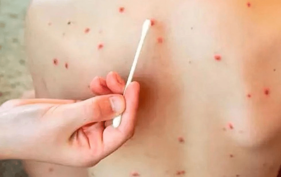 Suman 14 muertes por sarampión en Chihuahua: SSE