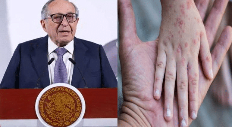 México registró más de 4 mil casos de sarampión y 17 muertes