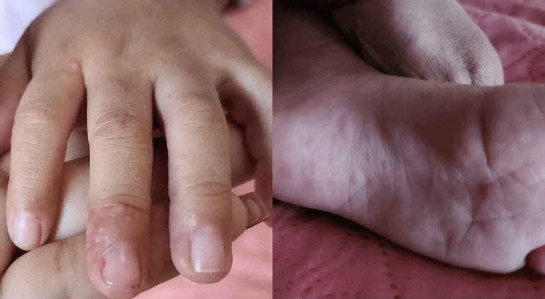 Tomarán clases en línea en Puebla por contagios de v1rus boca-pie-mano