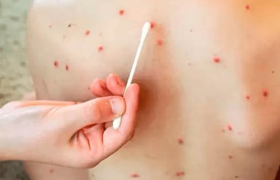 Prolongan hasta febrero de 2026 culminación del brote de sarampión