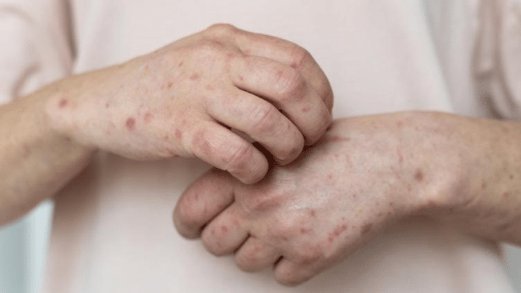 Alerta en México por aumento en casos de sarampión