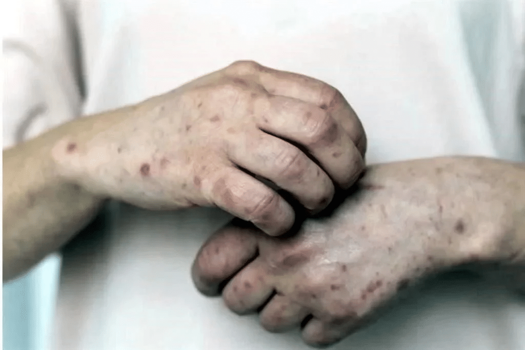 Concentra México 71% de casos de sarampión en región: OPS