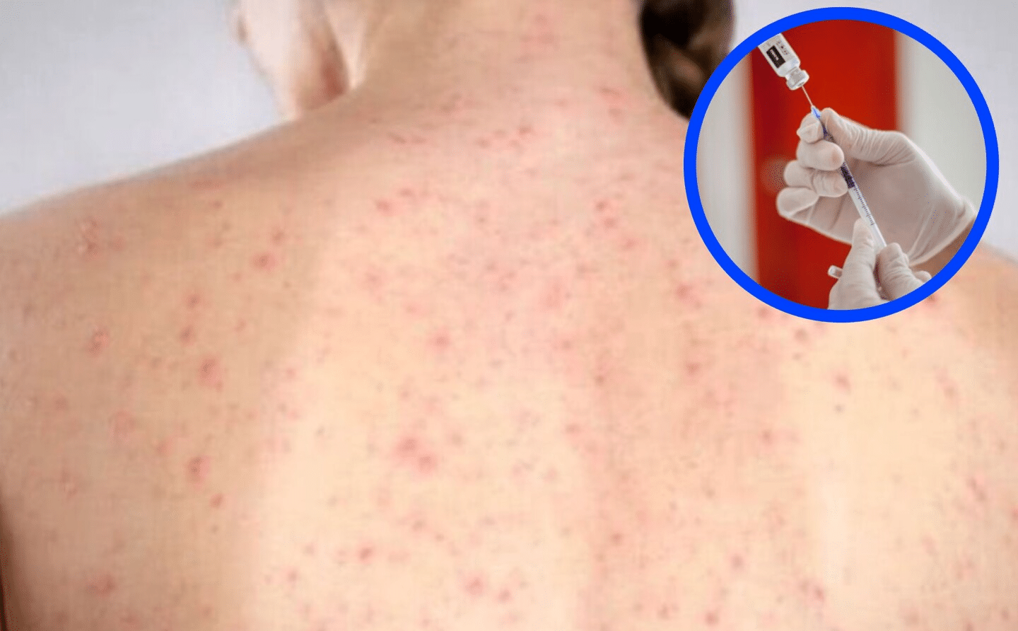 Investigan segunda posible muerte por sarampión en CDMX