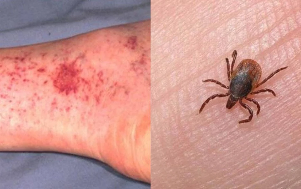 Mu3r3n la mitad de los pacientes picados por garrapatas en el estado
